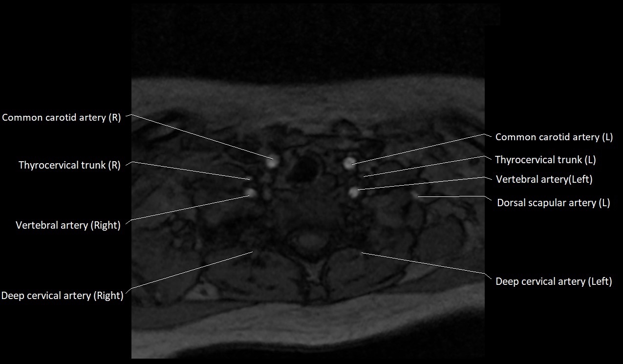 Carotid artery anatomy axial 3T image 64.jpg